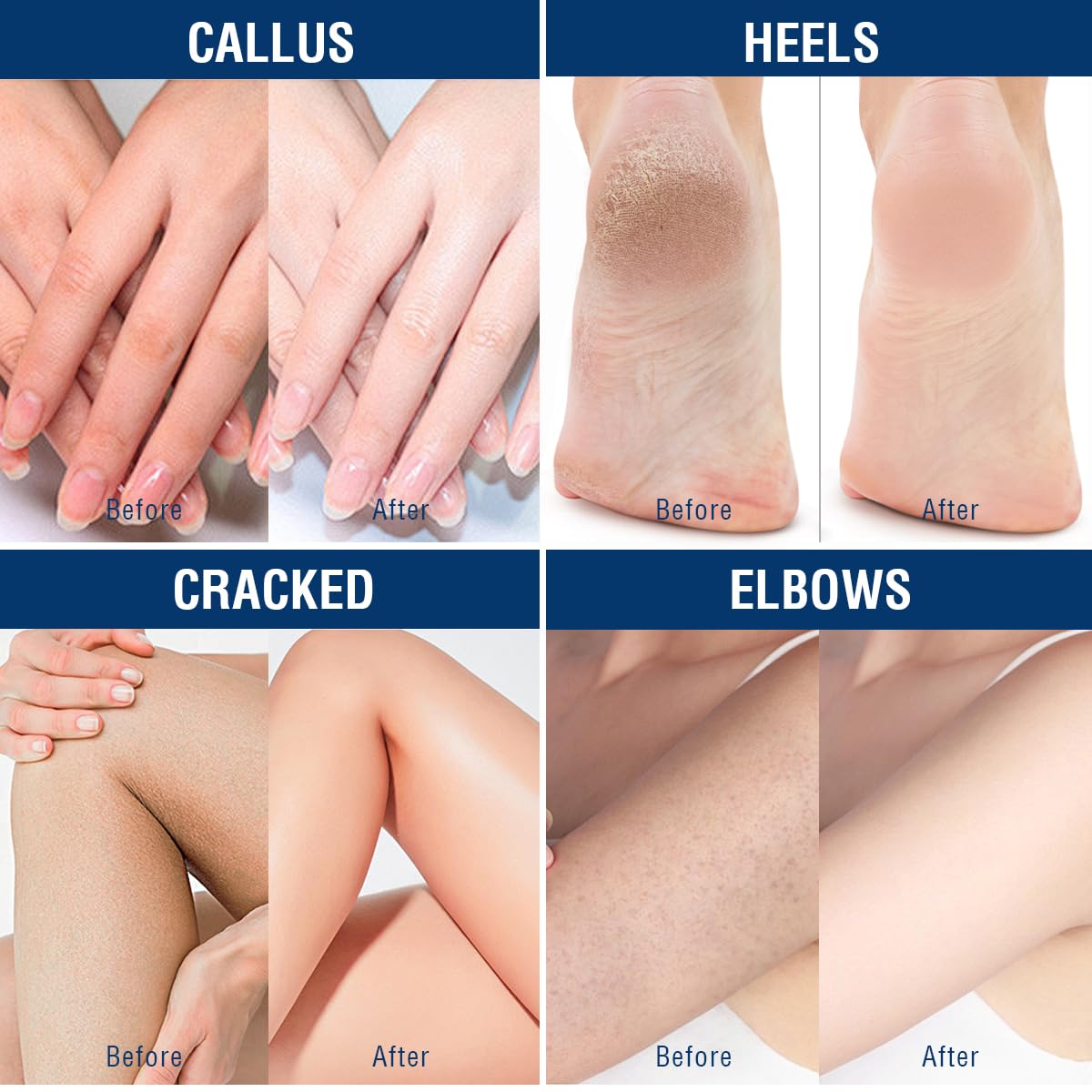 40% Urea Foot & Hand Cream for Dry, Cracked Skin